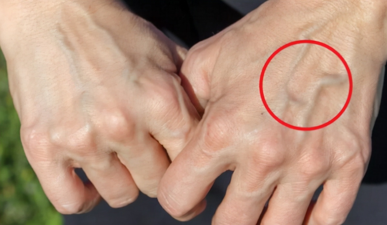 有些人手臂上“青筋暴起”，有些人却看不到青筋，哪种更健康呢？