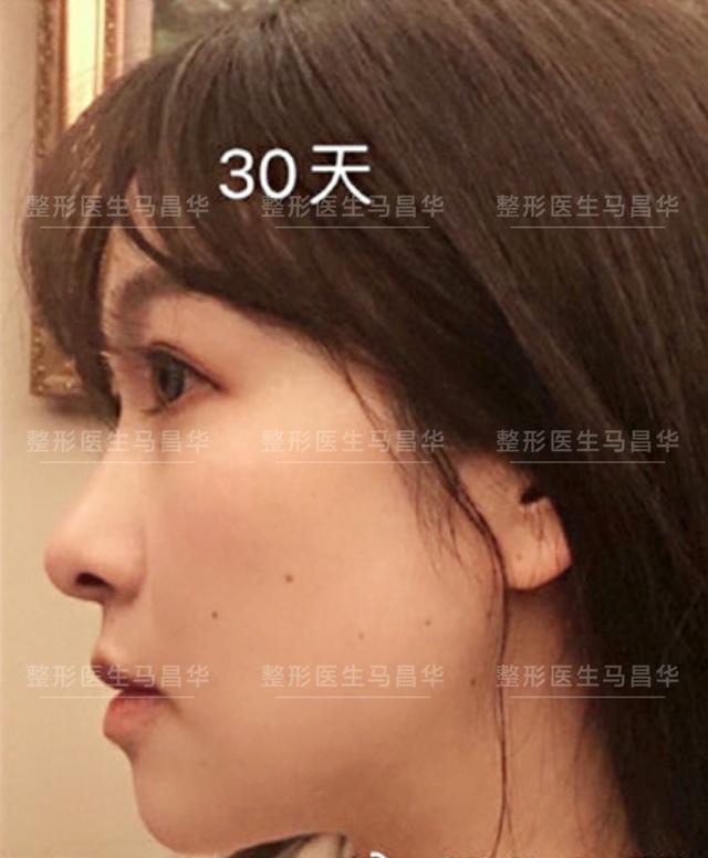 面部下颌缘吸脂术后即刻分享，面吸术后30天，她说她变回妙龄少女