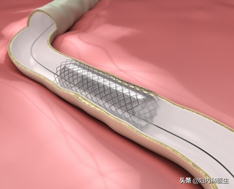 进口支架价格放置心脏支架选择进口的好还是国产的好