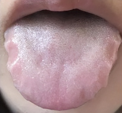 舌苔厚腻且有齿痕，是什么问题？教你看舌苔辨健康
