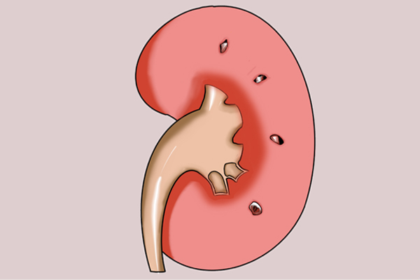 当出现肾衰时，5个尿液特征较为明显，预防肾衰竭应该做好3点