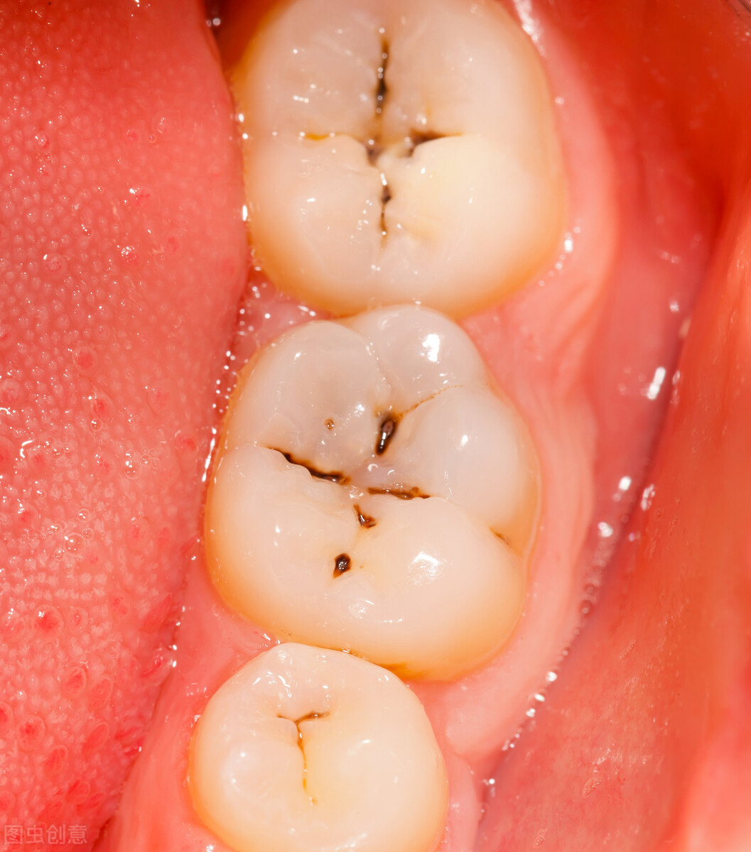 这句话也间接地告知大家牙疼是一件多么痛苦的事情,那么蛀牙疼痛难忍