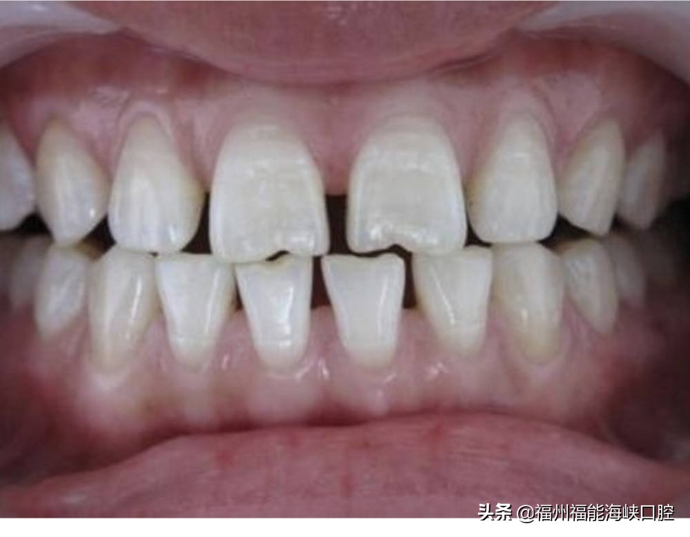 牙缝大是什么征兆？牙医：牙缝变大的主要原因、解决方法已整理好