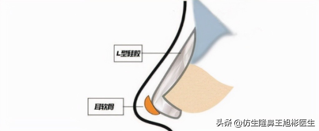 广州鼻修复｜线雕+伪综合，2次隆鼻失败修复后，她宛若天生轻混血