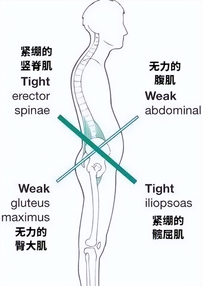 腰痛？膝痛？骨盆前倾？可能是下交叉综合征，只需四步解决