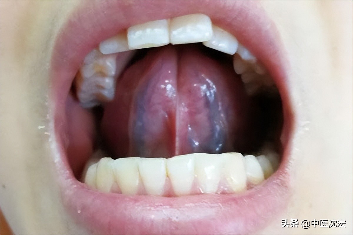 舌頭底下有兩條“大青筋”，代表身體出問題了？ 又該如何調理？