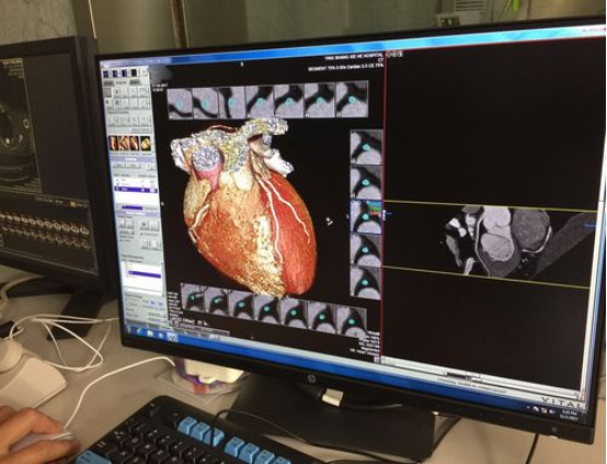 冠心病检查不只有造影，更便宜、有效地检查门诊就能做，值得收藏