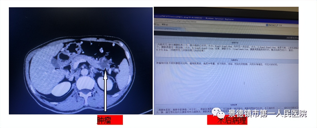 best365体育官方网站肝胆外科成功完成数例高难度胰腺手术