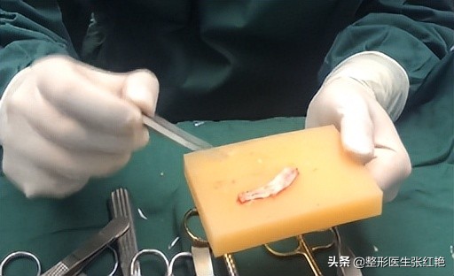 注射隆鼻效果怎么样（注射玻尿酸后做鼻综合，算初鼻还是修复？）