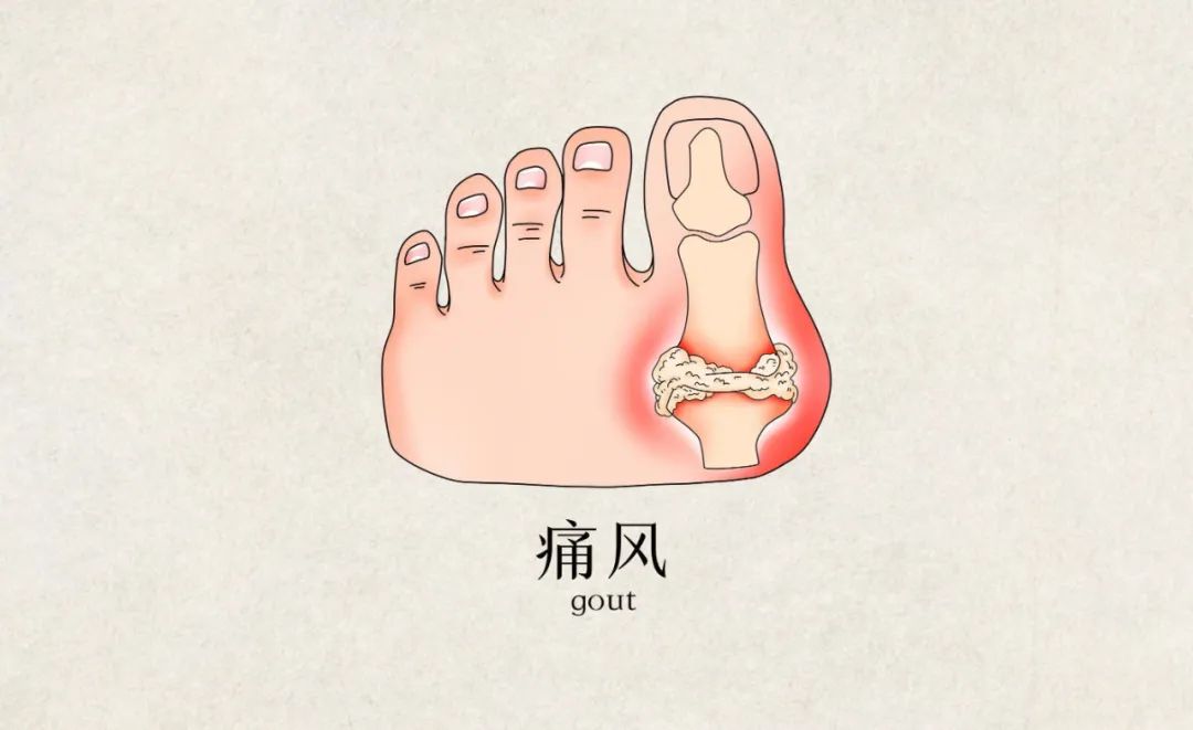 可能是痛风石的表现,3大危害要熟知