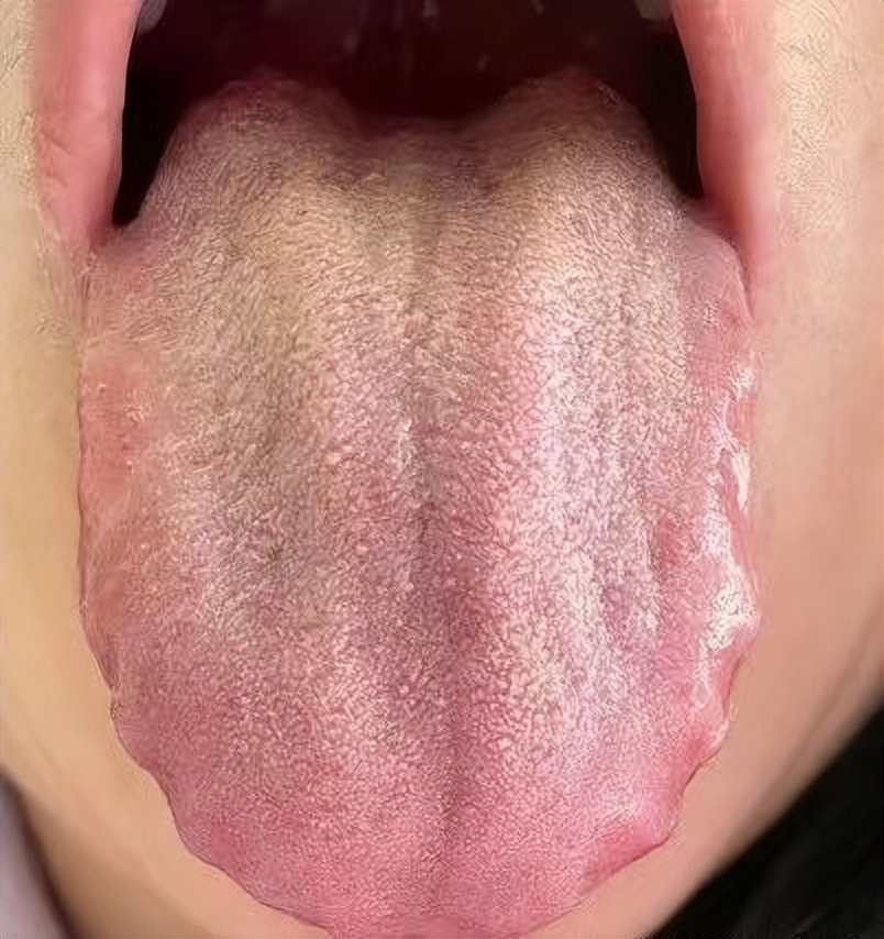 胰腺炎的舌苔图片图片