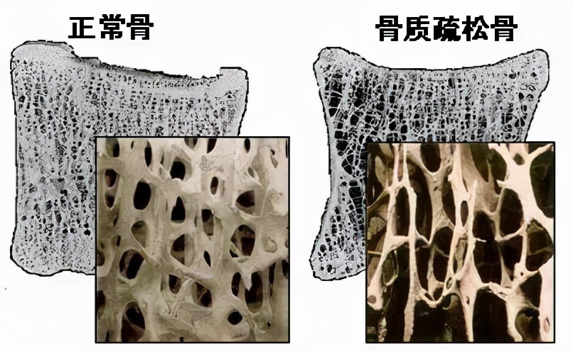 不死的癌癥：冬季高發(fā)的骨關(guān)節(jié)疾病