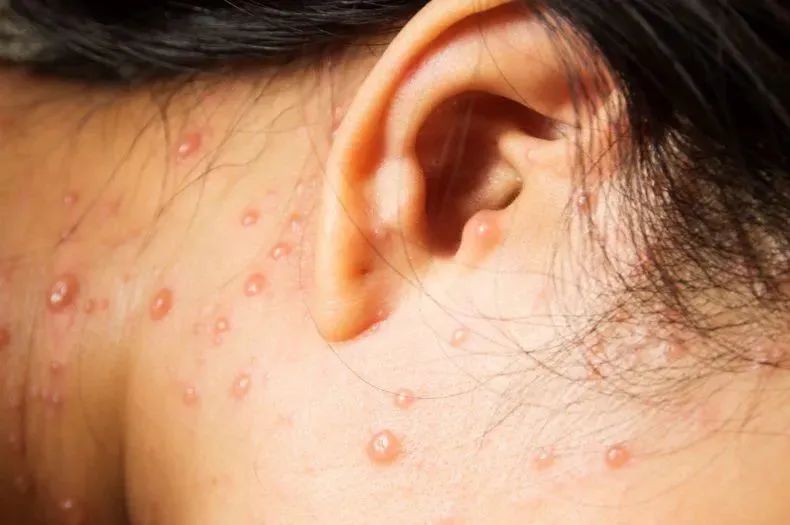 大学室友得水痘怎么办,大学室友得水痘不隔离怎么办-爱妻自媒体