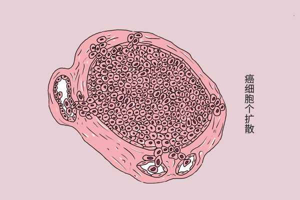 研究发现：运动可以消灭癌细胞，癌友坚持运动，身体会怎样？