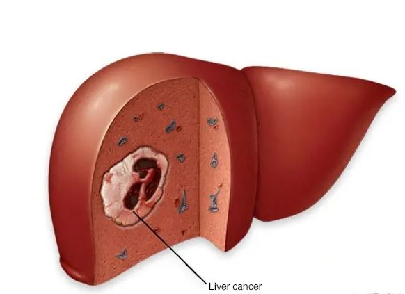 48岁的女子被诊断为肝癌，提醒：无端出现这4种症状要警惕