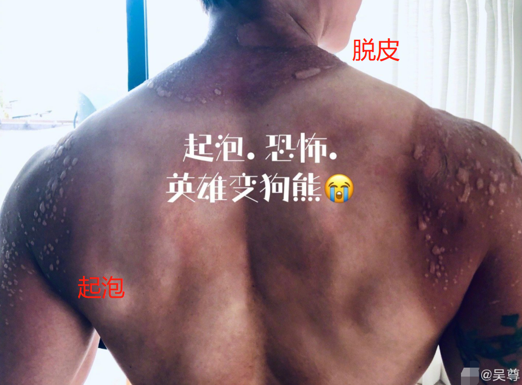 男星吴尊打球晒伤好严重！背部起三大片水泡，脖子上脱皮痕迹明显