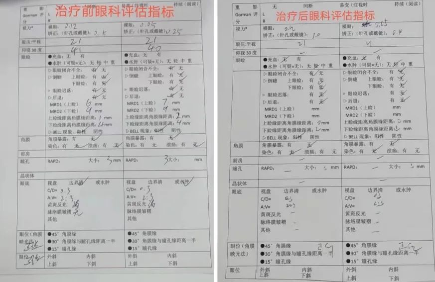 顺德甲亢专科在哪里(“甲亢突眼”到底怎么办？MDT专家携手为“大眼睛”患者解难题)