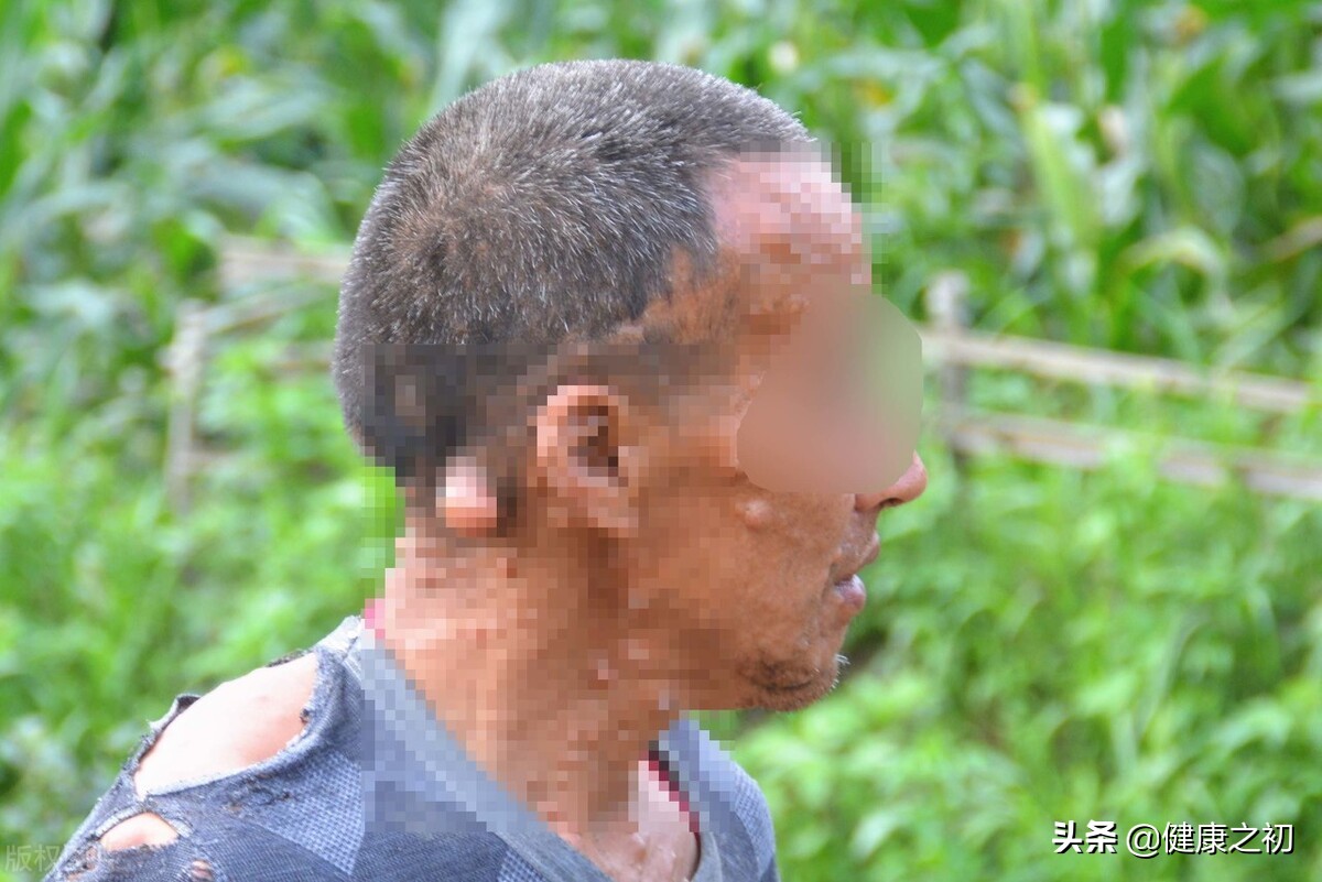 身上长满肉疙瘩，不疼不痒，怎么办？医生确诊：脂肪瘤，不用担心