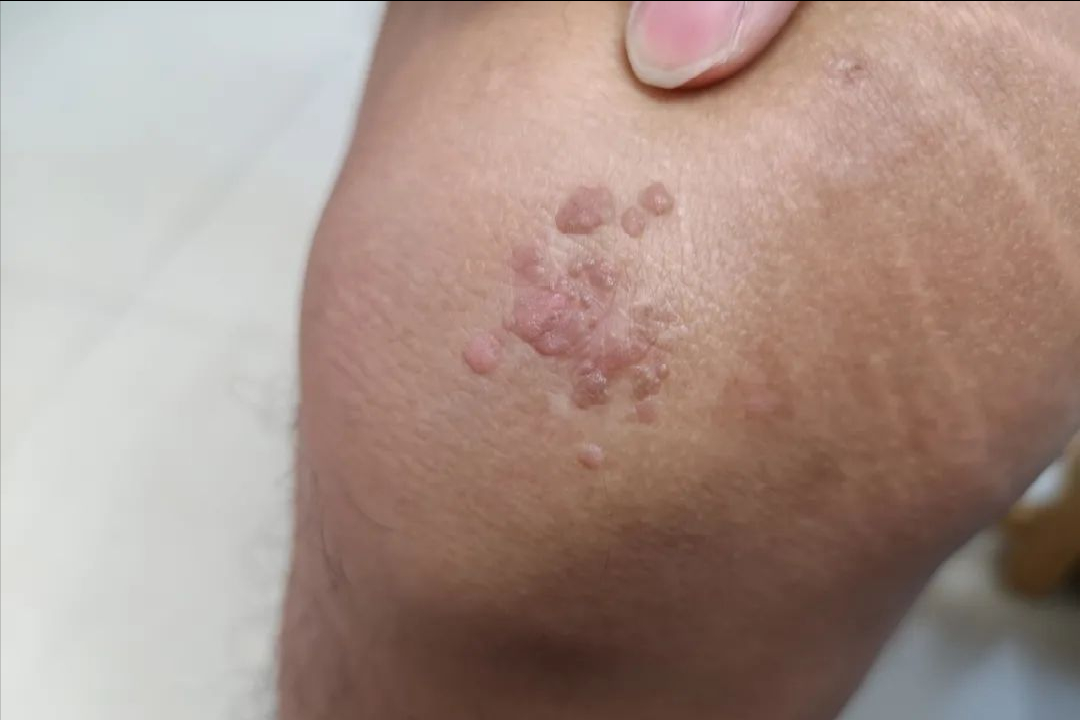 hpv和病毒疣都啥模样?