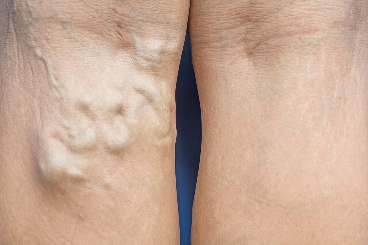 千古名方桂枝茯苓丸,专克血瘀,囊肿,8大功效请记牢