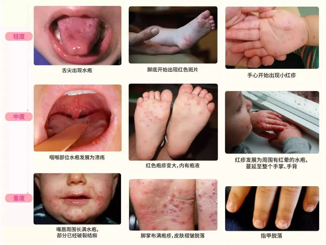 手足口病怎么传染(手足口病)