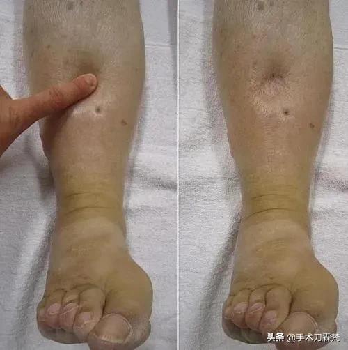 身体浮肿是什么疾病的症状,身体浮肿浑身没劲是什么原因