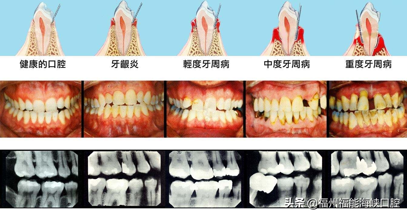 无法保留！29岁女子因牙周炎掉一大半牙！你的牙周还好吗？