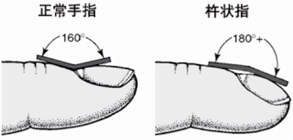 手指杵了(手指肿成“萝卜头”，出现杵状指，一定是肺癌吗？)