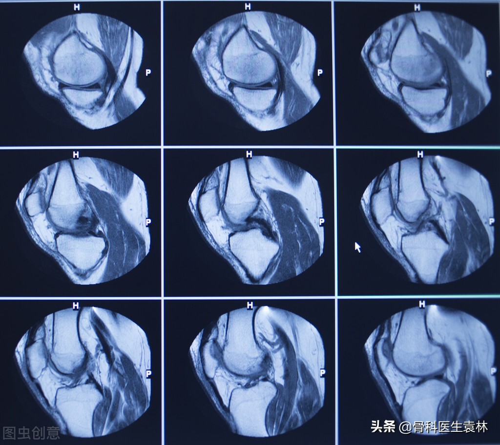 轻度的半月板损伤，可自行恢复吗？_膝关节半月板损伤 - 好大夫在线