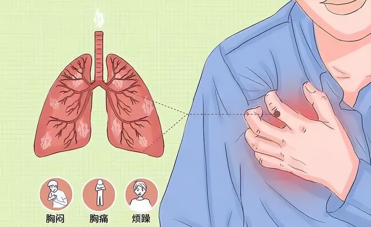 今天带大家了解一下导致胸痛的肺部疾病,提到肺部引起的胸痛,必须要