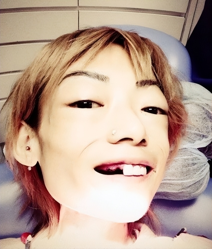 伍智恒: 嫁入豪门8年色衰被弃,牙齿掉光,胃被切除,体重只有44斤