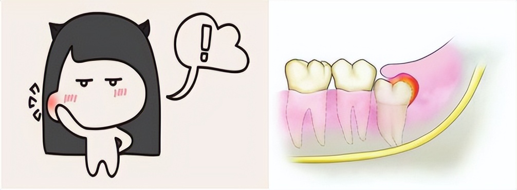 拔智齿后悔死了(拔智齿后悔死了！长了智齿，一定要拔吗？)
