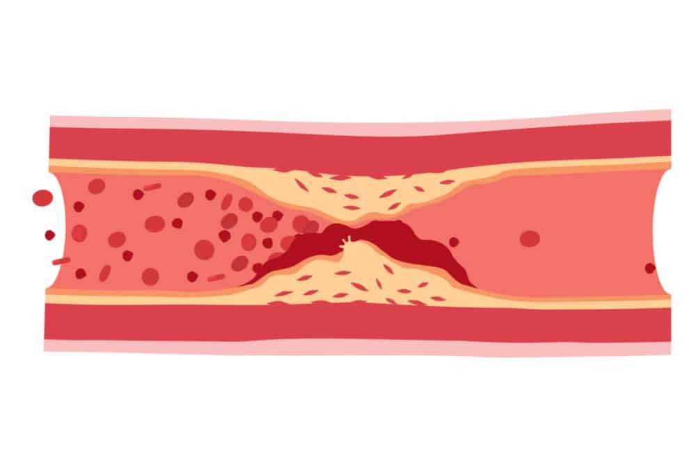 血管硬化怎么才能消除和预防(为何血管中脂肪堆积，会导致动脉硬化？斑块可以消除吗，吃什么药)