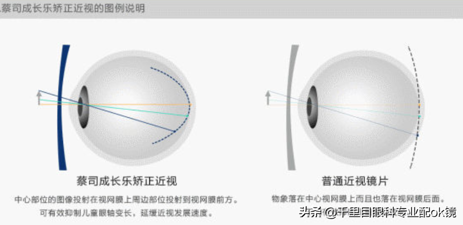 多点离焦近视控制眼镜优缺点-第4张图片-华展网