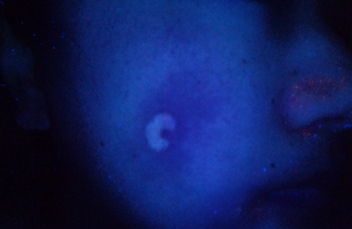 晕痣图片(晕痣型白癜风怎么治疗) - 赤虎壹号