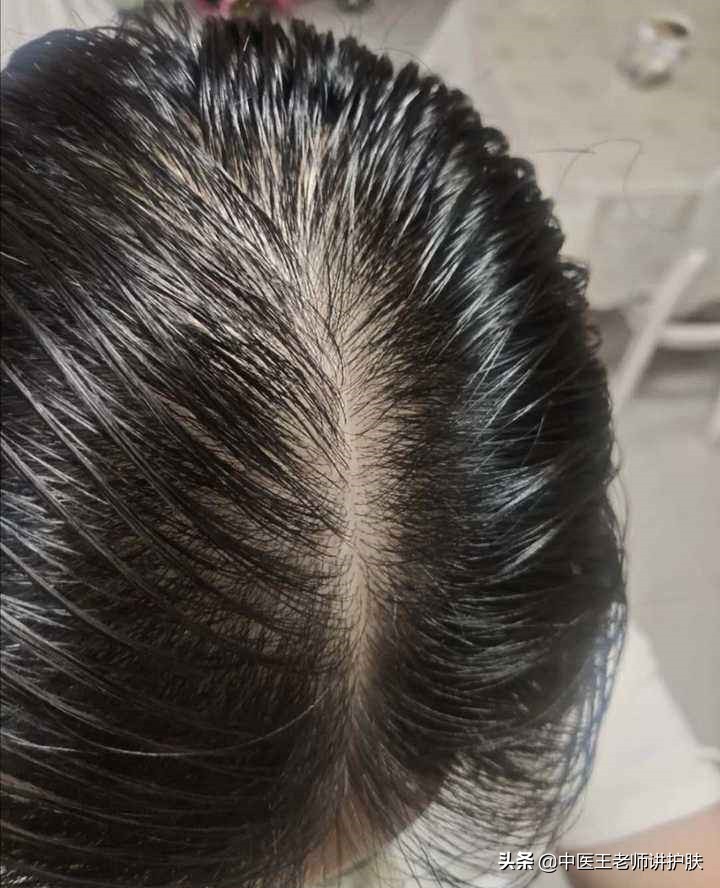 祛风邪?脂溢性脱发在病程的不同阶段该怎么治疗?