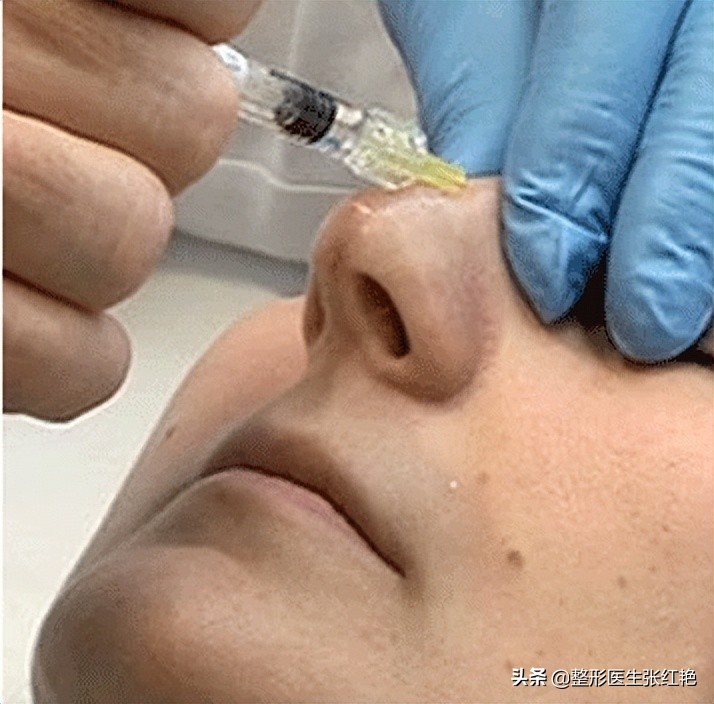 注射隆鼻效果怎么样（注射玻尿酸后做鼻综合，算初鼻还是修复？）