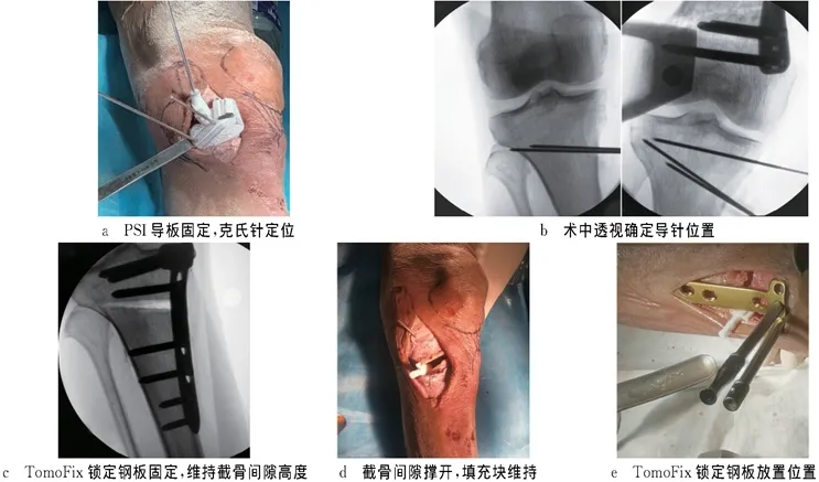 一种基于“H”点的全新3D打印个性化截骨导板辅助胫骨高位截骨术