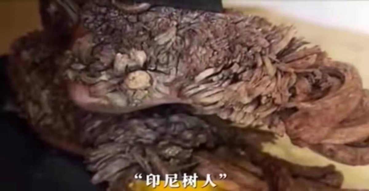 湖南44岁男子手脚长满木疙瘩，村医束手无策，医生说出了真相