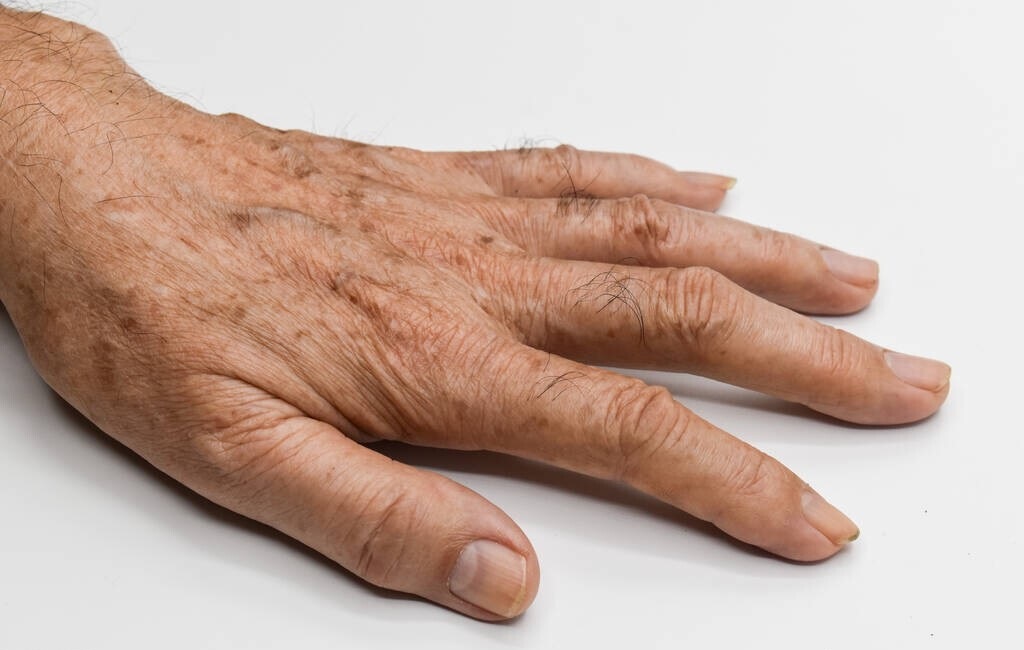 为什么年龄越大，身上的“黑点”越多，对健康有影响吗？