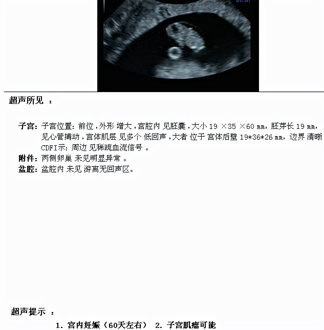 06.12一超:宫腔内见胚囊,大小18×14×21mm,胚芽长3mm,见心管搏动.