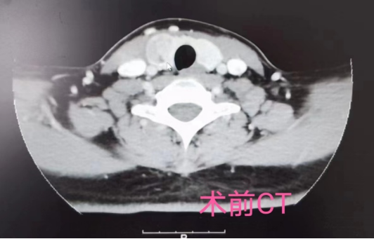 广西甲状腺结节去哪里治疗(甲状腺囊实性结节治疗新选择——微波消融助力实现“去病无痕”)