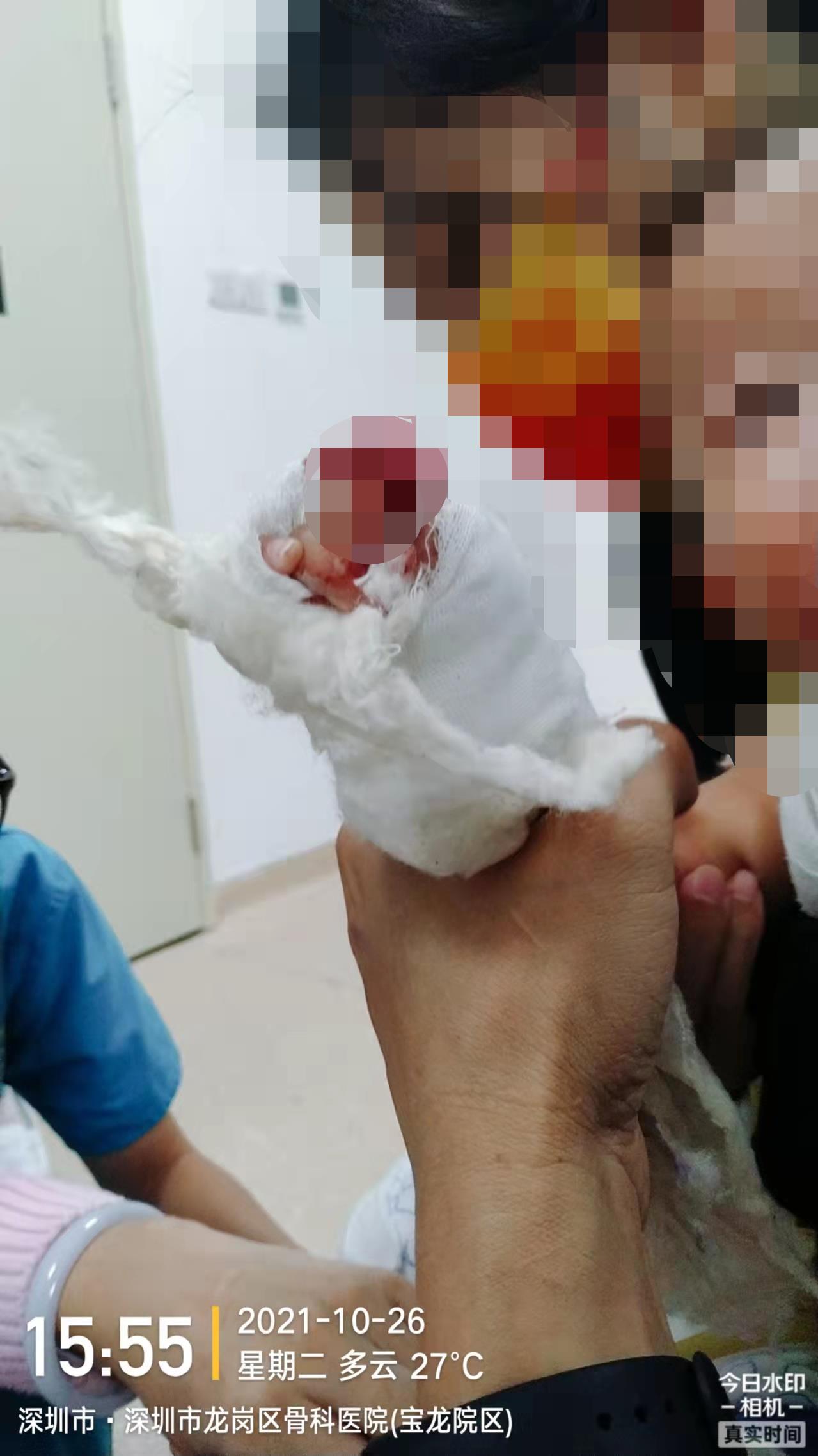 11个月大女婴拆石膏时一截手指被医生剪断，家长：断指已再植，医院：深感痛心和歉意，当事医生已离职