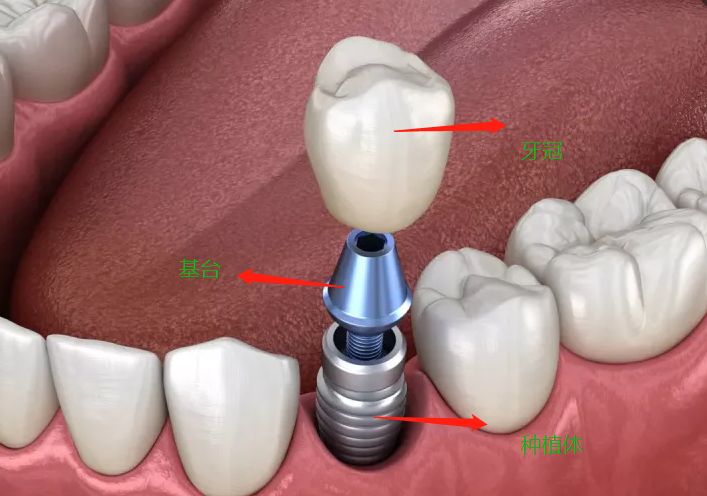 种植牙真的很可怕？五六千与一万多的差别在哪里？种后可以管多久