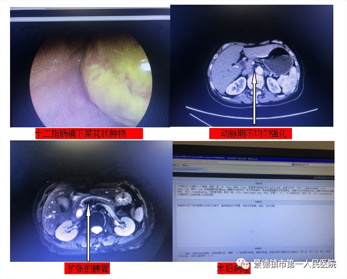 best365体育官方网站肝胆外科成功完成数例高难度胰腺手术