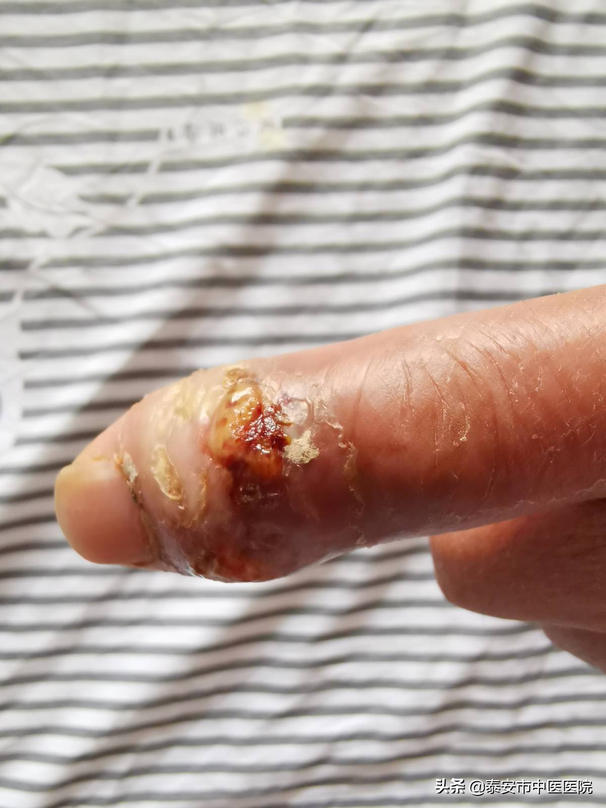 技术守护健康——泰安市中医医院善用微创水筋针治疗手指痛风石破溃