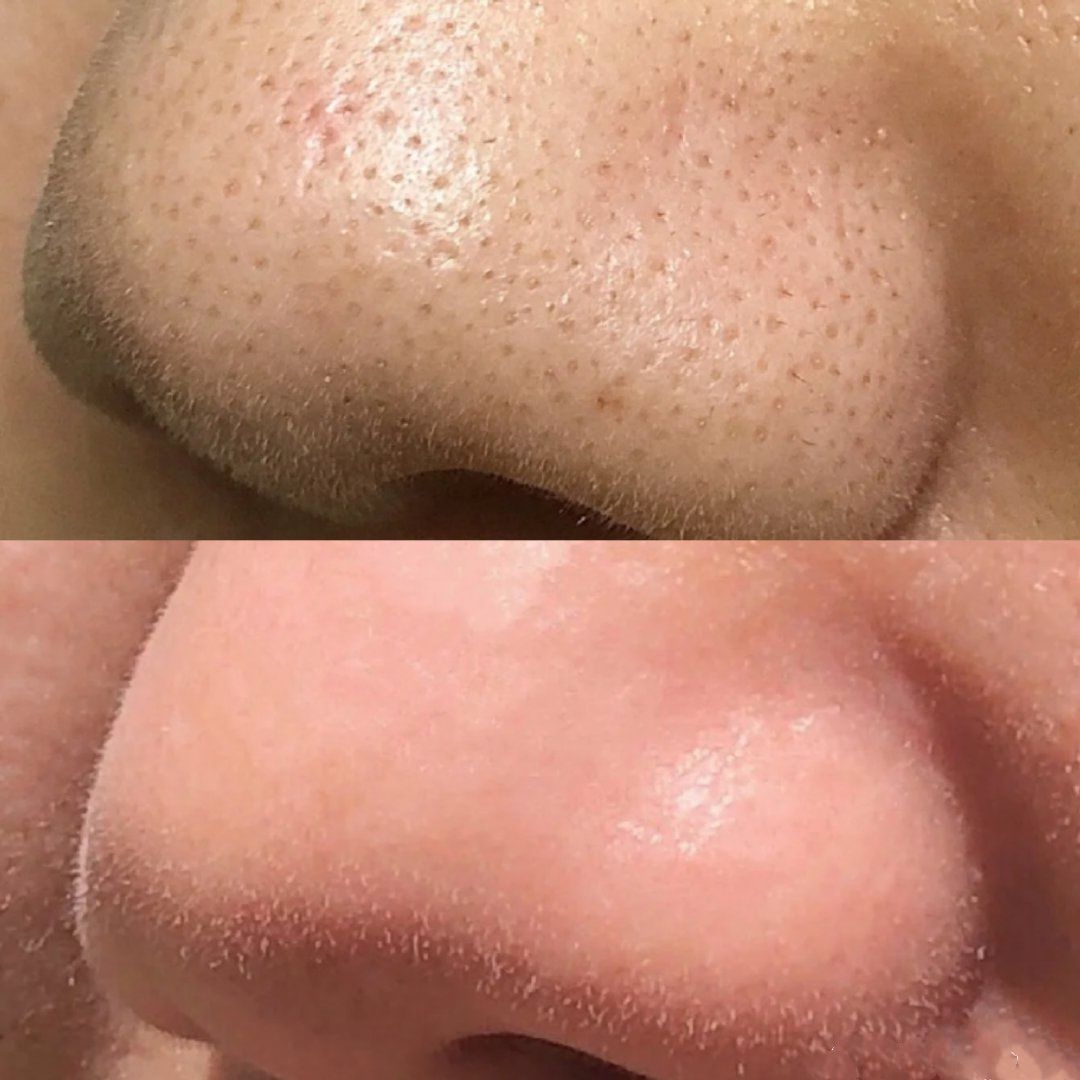 到美容院去黑头多少钱?