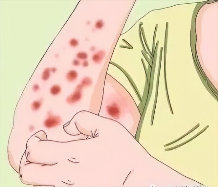 过敏性荨麻疹卡通图片