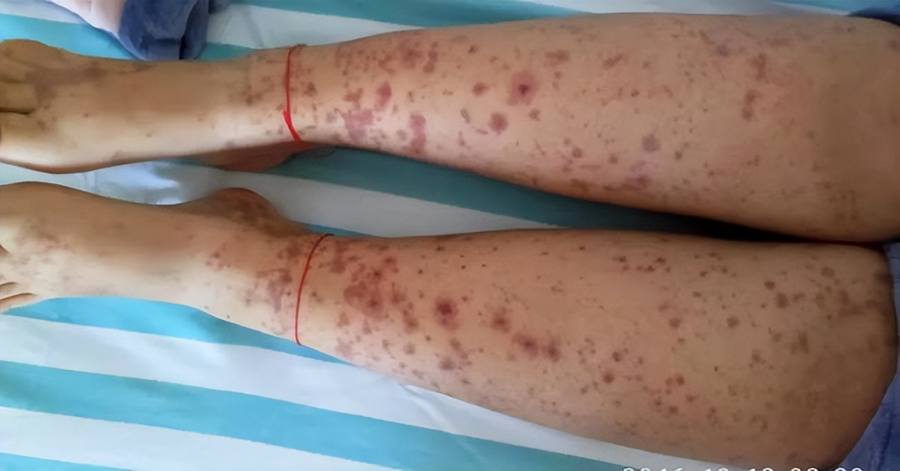 生活中,怎么做才能有效预防血小板减少性紫癜?