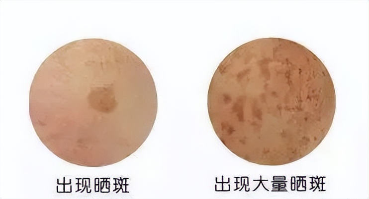 怎么樣能祛斑（別踩雷啦，真正有效的祛斑方法都在這了）